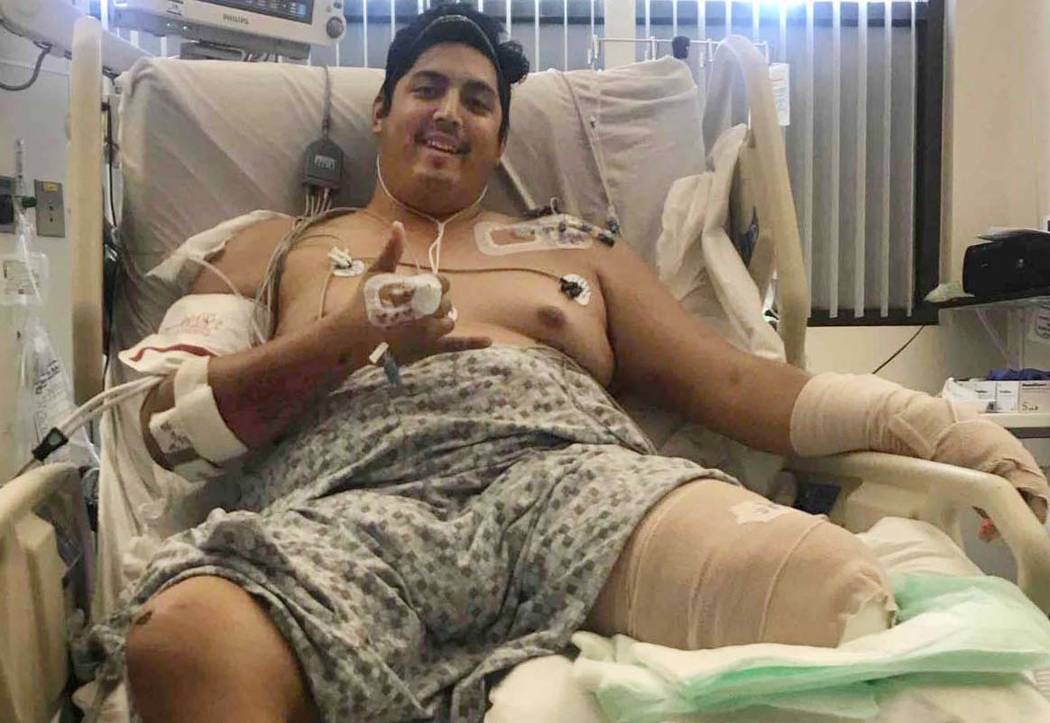 A Tim Gierczic le amputaron la pierna izquierda por debajo de la rodilla después de que se lesionó cuando un conductor de una camioneta lo golpeó mientras conducía su motocicleta en marzo, des ...