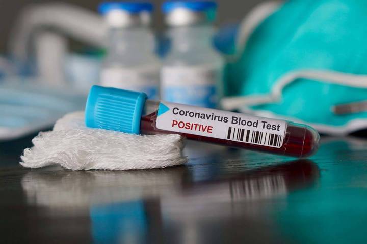 Resultado positivo de análisis de sangre para el nuevo Coronavirus de rápida propagación. (G ...