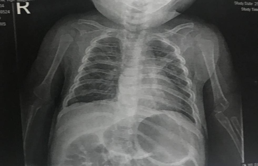 La radiografía de tórax de Caleb Anderson tomada el miércoles, 25 de marzo de 2020 en el Cen ...