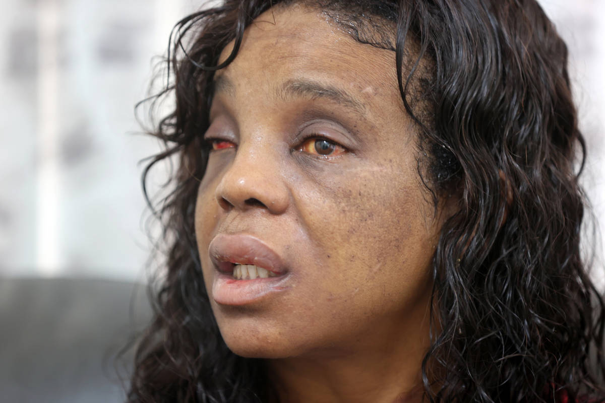 Latoshia Johnson, que lucha por abrir los ojos tras una fuerte paliza, habla con un periodista ...