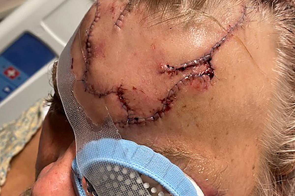 Allen Minish presenta laceraciones en la cabeza mientras se recupera en un hospital de Anchorag ...