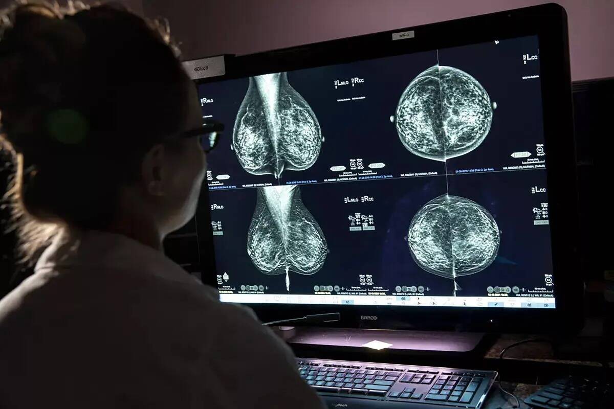 Un informe de recomendación del U.S. Preventive Services Task Forceseñala que las mamografía ...