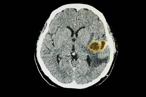 Tomografía computarizada cerebral de una paciente con grandes abscesos cerebrales en el lóbul ...
