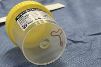 Esta foto sin fecha facilitada por Canberra Health Services muestra un parásito en un frasco d ...