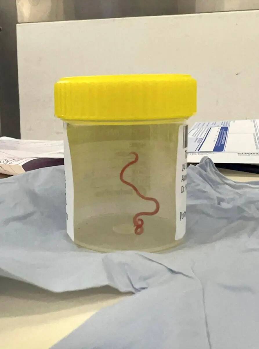 Esta foto sin fecha facilitada por Canberra Health Services, muestra un parásito en un frasco ...