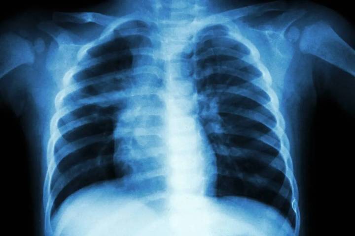 No se conocen casos adicionales de tuberculosis activa -hasta ahora- de una persona con tubercu ...