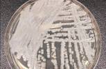 Los casos del hongo ‘superbacteria’ alcanzan una cifra récord en el sur de Nevada